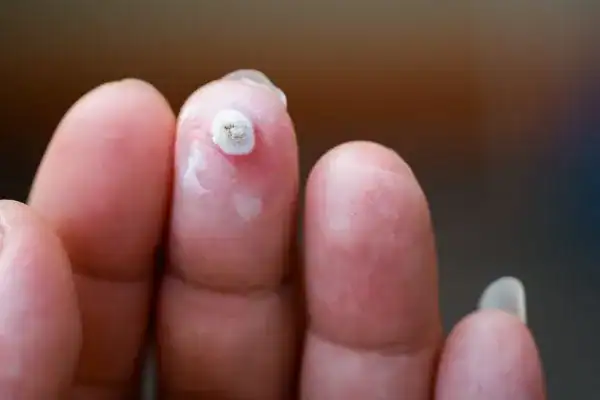 Image of white wart before cryopen treatment Surbiton