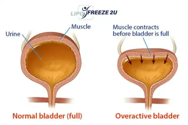 diagram of overactive bladder treatment Surbiton