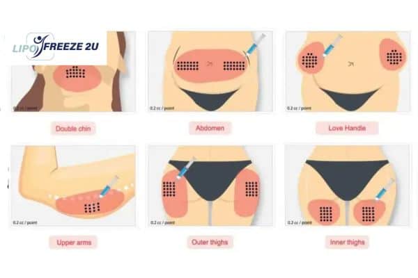 Benefits of Choosing Aqualyx for Fat Reduction Surbiton
