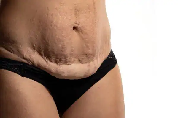 loose skin after weight loss injections Surbiton