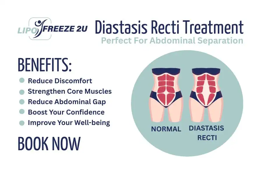 Benefits of body toning treatment Surbiton for Diastasis recti