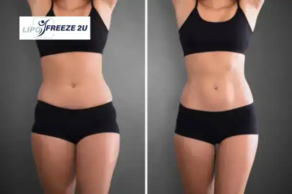 How Can LIPO FREEZE 2U Support Your Post-Pregnancy Body Recovery Surbiton?