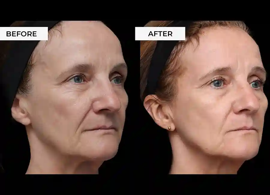 How Many RF Microneedling Sessions Will You Need to See a Difference Surbiton?