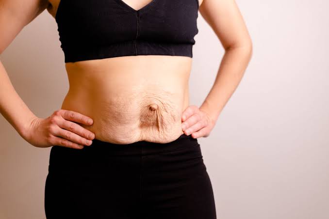 Is Surgery Really the Only Way to Repair Diastasis Recti Surbiton?