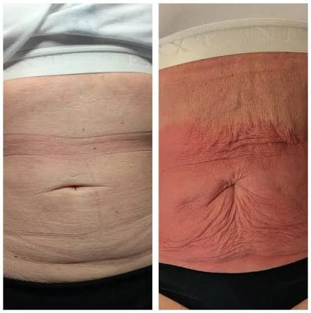 How Does RF Microneedling Improve Crepey, Thin and Uneven Skin Texture Surbiton?