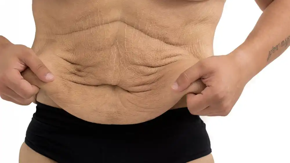 RF Microneedling for Loose Skin: How Can It Help Tighten and Reshape the Skin Surbiton?